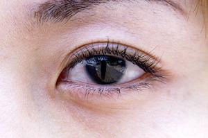 宮城において埋没法をしたいなら